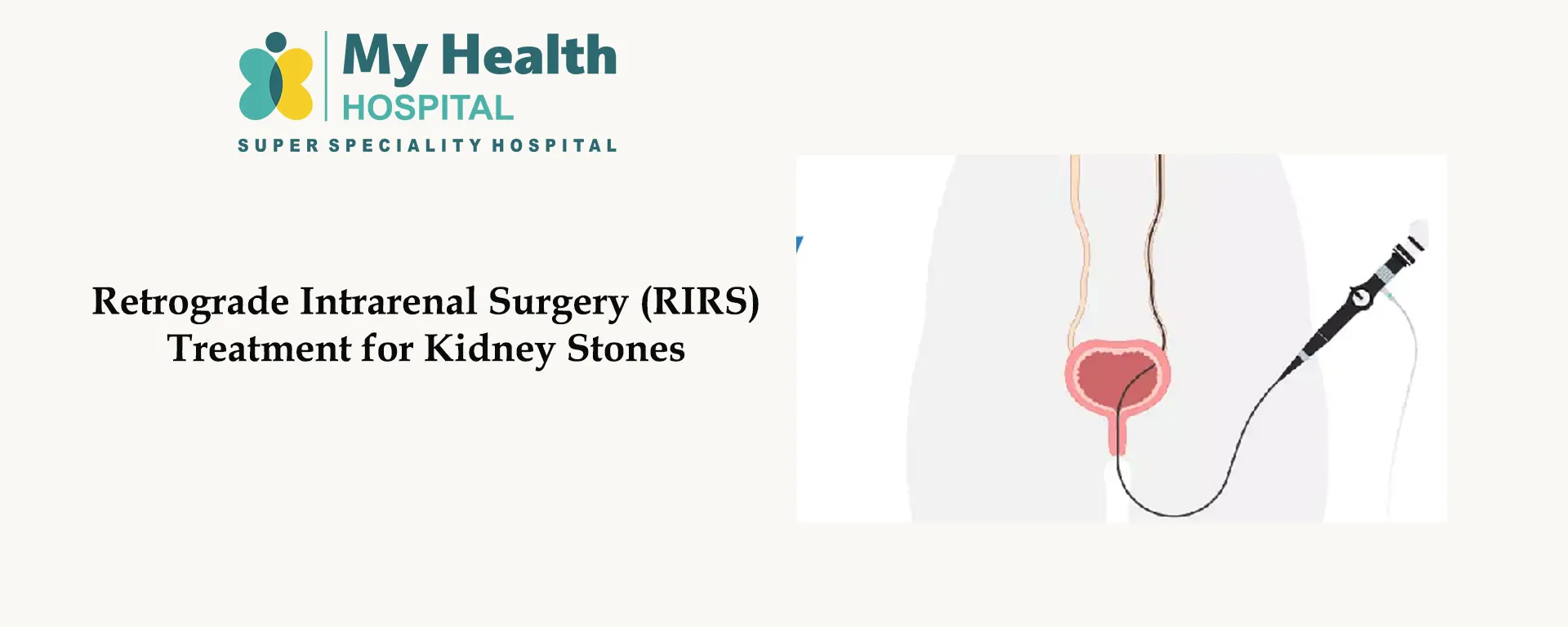 Retrograde Intrarenal Surgery (RIRS) Treatment for Kidney Stones